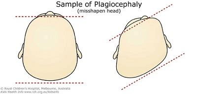 Kids Health Info : Plagiocephaly - misshapen head