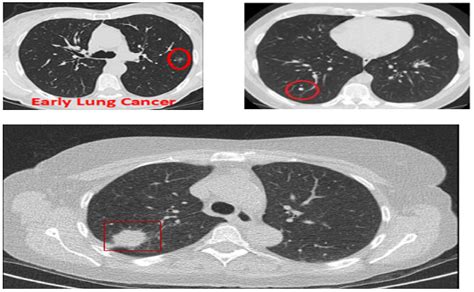 Benign Lung Tumor