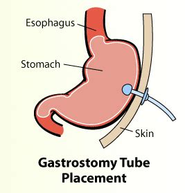 When is it time for a G-tube? | NBIA