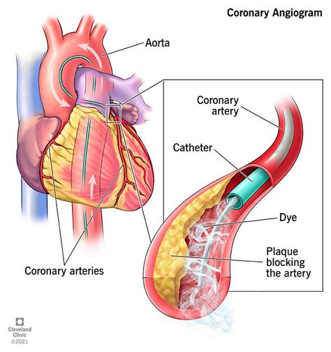 Coronary Angiogram: Procedure Details