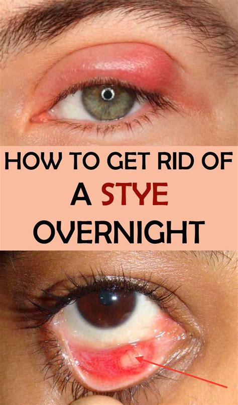 How To Get Rid Of a Stye Overnight - Beauty-TipsZone.com | Eye stye ...