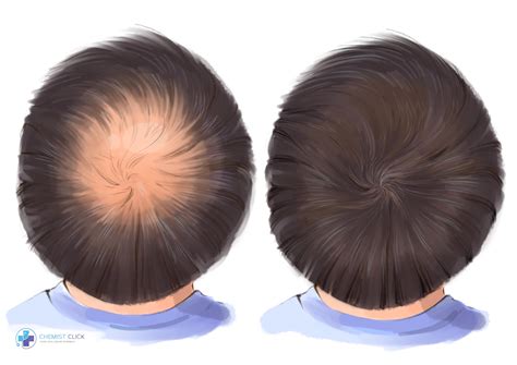 Finasteride: Before and After (with pictures)