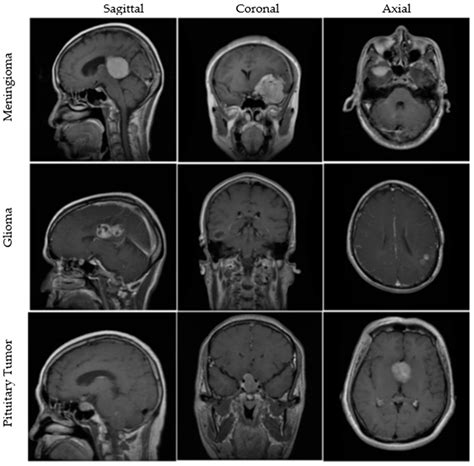 Mri Brain Tumor Pituitary