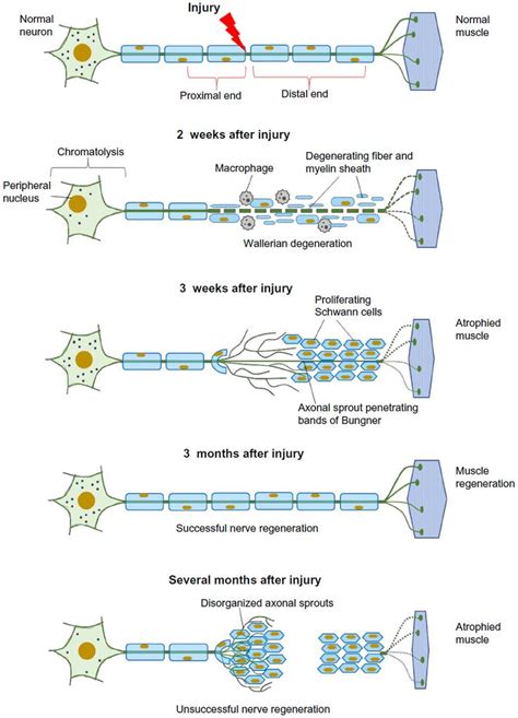 degeneration and regeneration of a nerve | Peripheral nerve injury ...