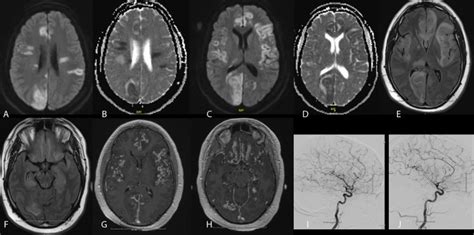 Neurosarcoidosis Flare with Multifocal Restricted Diffusion: Stroke ...