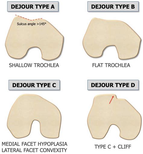 JPM | Free Full-Text | Framing Patellar Instability: From Diagnosis to ...