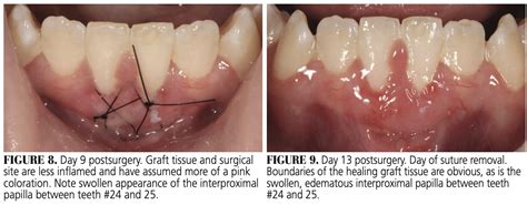 Healing Progression of the Free Gingival Graft - Decisions in Dentistry