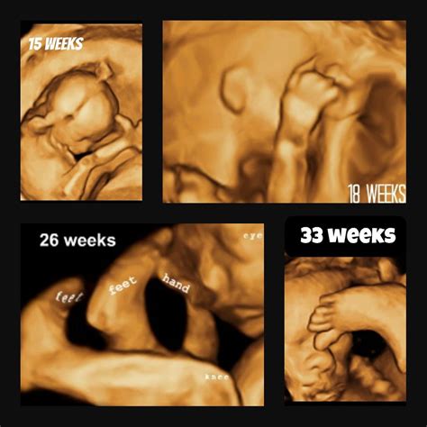 Pin on 3D Ultrasound. 4D Ultrasound. Gender Determination.