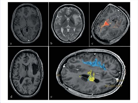 MRI of patient B. with tumor of the left insular lobe. а ...