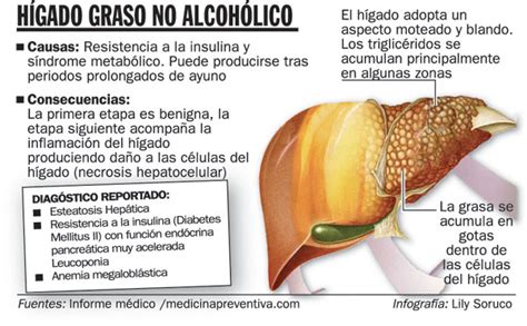 Los 5 Enemigos Del Higado: HÍGADO GRASO