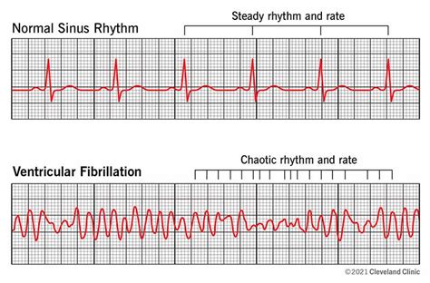 Ventricular Fibrillation (V-Fib): Symptoms & Treatment