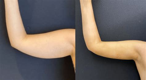 Before & After: Arms Liposuction - Neinstein Plastic Surgery