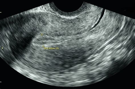 Chapter 3 – Gynaecology Ultrasound | Obgyn Key