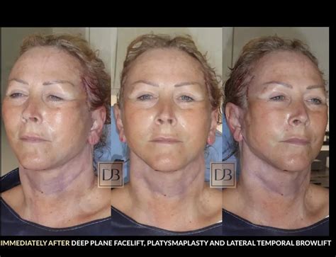 Stages of Facelift Recovery | Dr. Dominic Bray