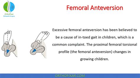 Femoral Anteversion Angle