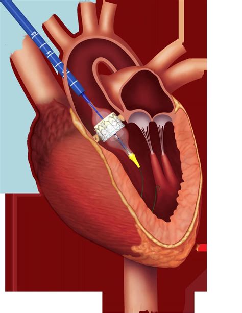 Trans-Aortic Transcatheter Aortic Valve Replacement with Edwards Sapien ...