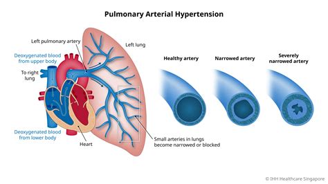 Pulmonary Arterial Hypertension - Symptoms & Causes | Parkway Shenton