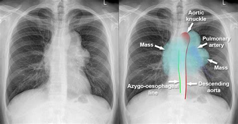 Chest X-ray - Mediastinum and hilum - Anterior mediastinal mass