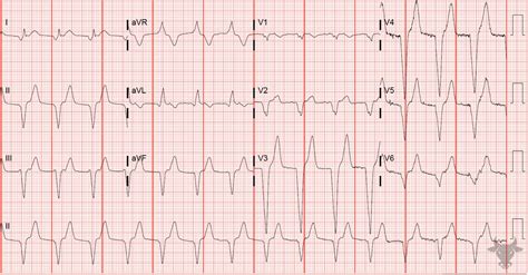 Accelerated Idioventricular Rhythm | ECG Stampede