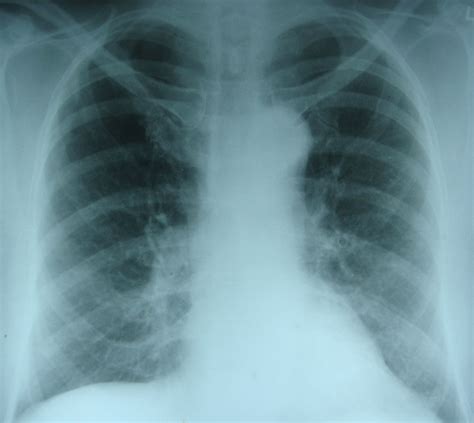 Pulmonary Edema X Ray Chest Pa View All About Cardiovascular System ...