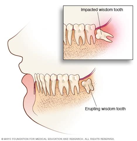 How To Help Wisdom Tooth Pain - Askexcitement5