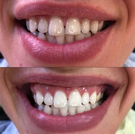 Teeth Whitening: Price & Appointment in Miami, Sunny Isles Beach