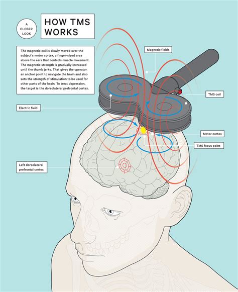 The Buzz Around Brain Stimulation | Transcranial Magnetic Stimulation