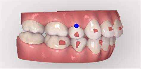 When Do Invisalign Attachments Come Off? - 1311 Jackson Ave Dental ...