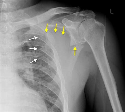 Scapular fracture - Radiology at St. Vincent's University Hospital