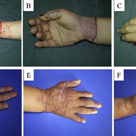 Total hand degloving injury (Case 1). (A) Before surgery. (B) Palm side ...