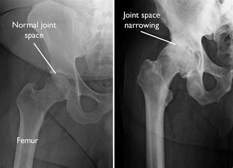 Osteophytes Hip