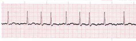 Identifying and Treating Atrial Fibrillation (AFib or AF)