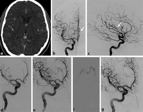 11: The Anterior Communicating Artery Complex | Radiology Key