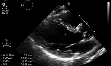 What Does An Echocardiogram Show? • MyHeart