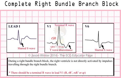 ECG Educator Blog : Bundle Branch Blocks