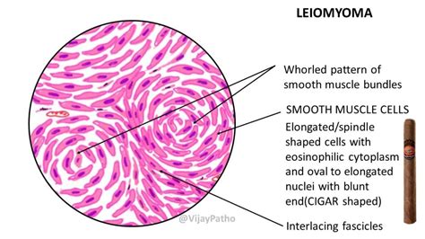 Pathology of Uterine Leiomyoma - Pathology Made Simple