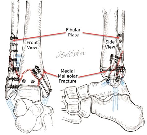 Ankle fracture and treatment – Sports Medicine and Orthopedics