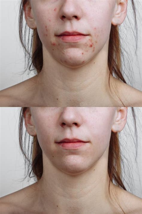 Young Woman before and after Acne Treatment, Closeup. Skin Care Concept ...