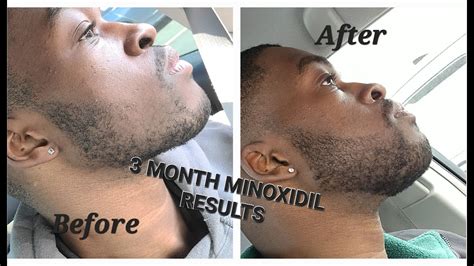 3 MONTH MINOXIDIL BEARD GROWTH RESULTS (TIPS AND TRICKS TO SPEED UP ...