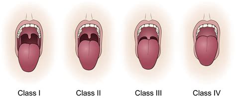 Sleep apnea score 10, chronic insomnia symptoms diagnosis, home ...