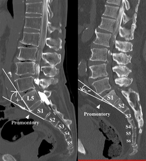 The anterior lumbosacral transitional angle is defined as the angle ...