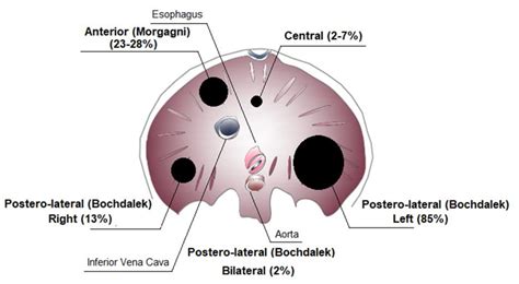 Congenital Diaphragmatic Hernia