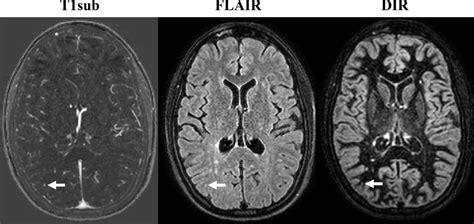 Axial MR Images Obtained in 32 [IMAGE] | EurekAlert! Science News Releases