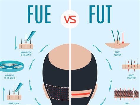 FUE and FUT: A Comparison to Choose the Best Method - Pure Dermatology