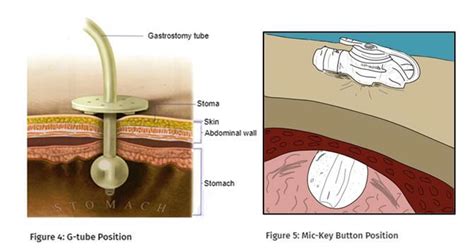 PEG Tube Placement Procedure|Nursing Care&Health Education