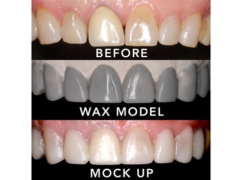 Visualize Your Smile - Diagnostic Wax-up - News - Spaulding Dental Co ...