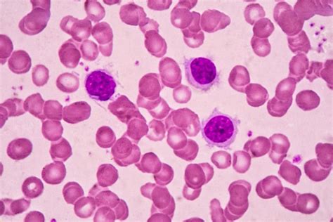 Causes and Treatment of Low Lymphocyte Count [Lymphocytopenia]