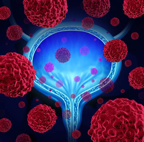 Blue Light Cystoscopy Increases Bladder Cancer Detection Rate - Renal ...