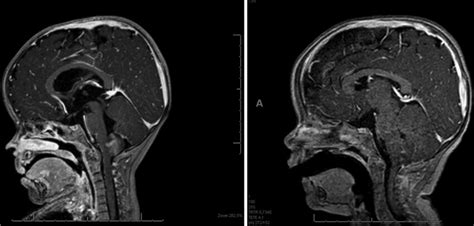 This female patient started daily emesis at 3 months old, along with ...