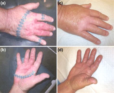 Dorsal (a) and ventral (b) surfaces of the right hand prior to ...